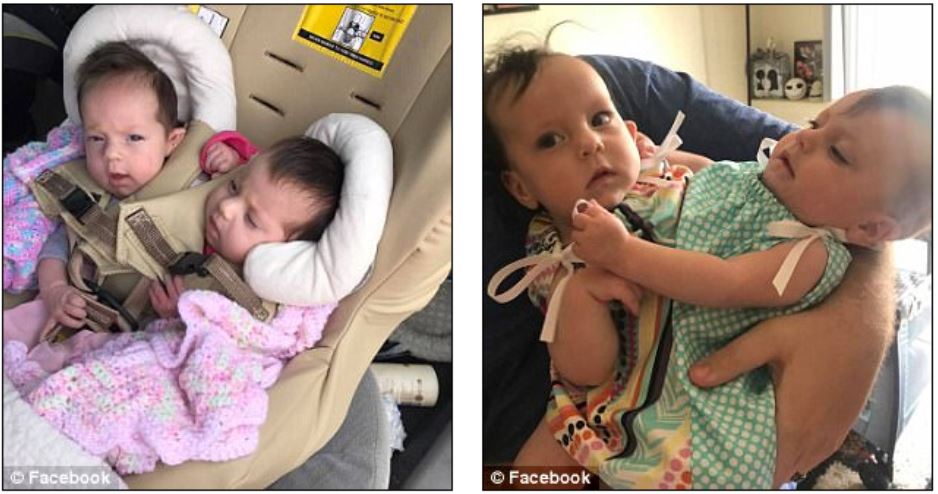 Jumeaux Conjoints A Campagne Quebec Vie