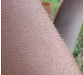 photo of cold human skin with goosebumps