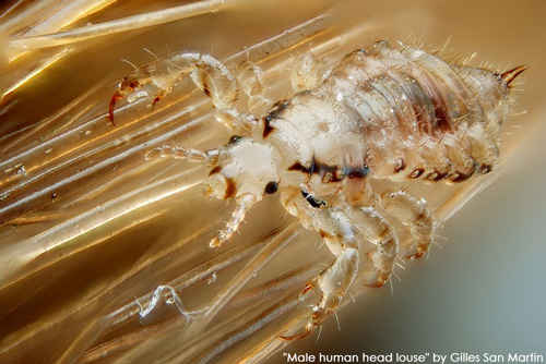 My Battle With Head Lice Northwest Center For Alternatives To