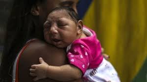 microcephaly.jpeg