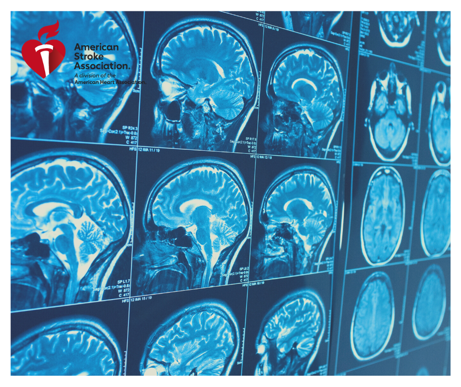 Stroke MRI